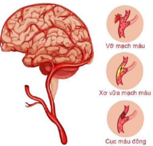 Sơ cấp cứu nạn nhân ĐỘT QUỴ NÃO tại cộng đồng