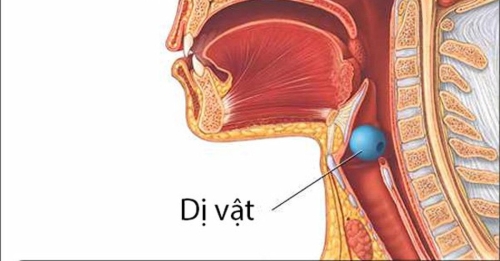 DỊ VẬT ĐƯỜNG THỞ VÀ CÁCH XỬ LÝ