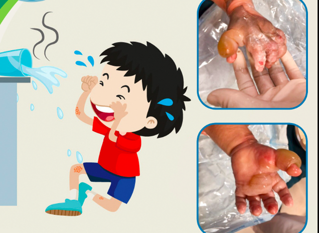Sơ cứu bỏng: Nguyên nhân, phân loại và cách sơ cứu dự phòng