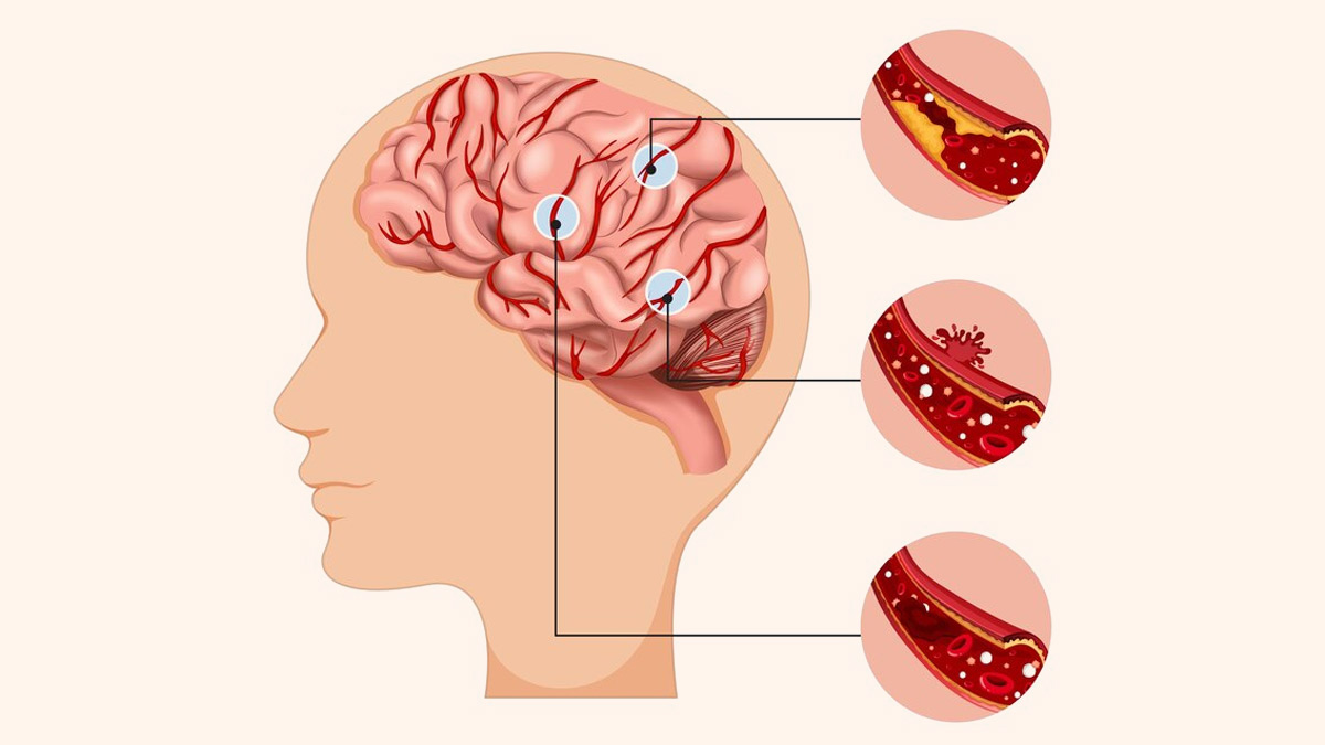 Trúng gió và đột quỵ - Nhận biết để phân biệt